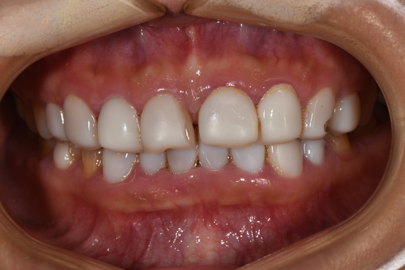 树脂贴面和烤瓷贴区别,贴面树脂的好还是烤瓷的好