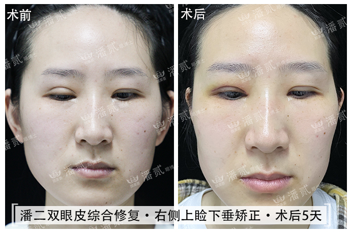 双眼皮术后恢复不一致正常吗,双眼皮术后看着不对称
