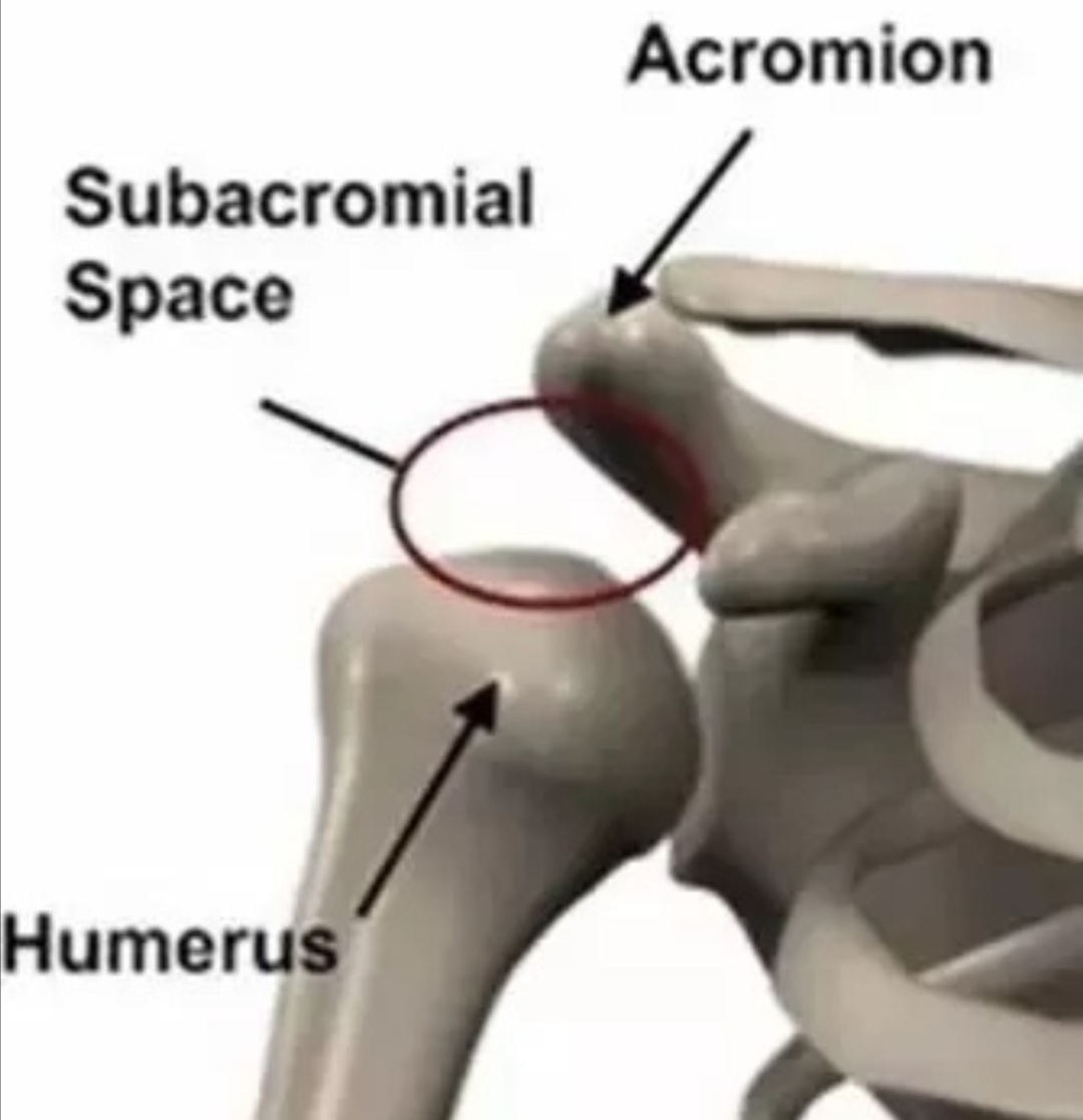 肩峰下撞击会引起什么症状,肩峰撞击导致手臂抬起来疼