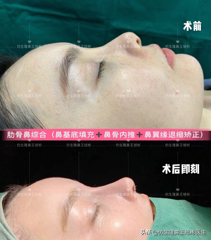 耳软骨隆鼻鼻小柱也是用耳软骨吗,耳软骨隆鼻可以摸到鼻尖的软骨吗