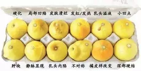 乳头溢液莫轻视，可能是身体发出的求救信号