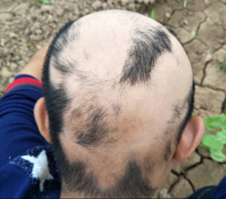 分享一些有什么解决脱发的方法吧,脱发分享