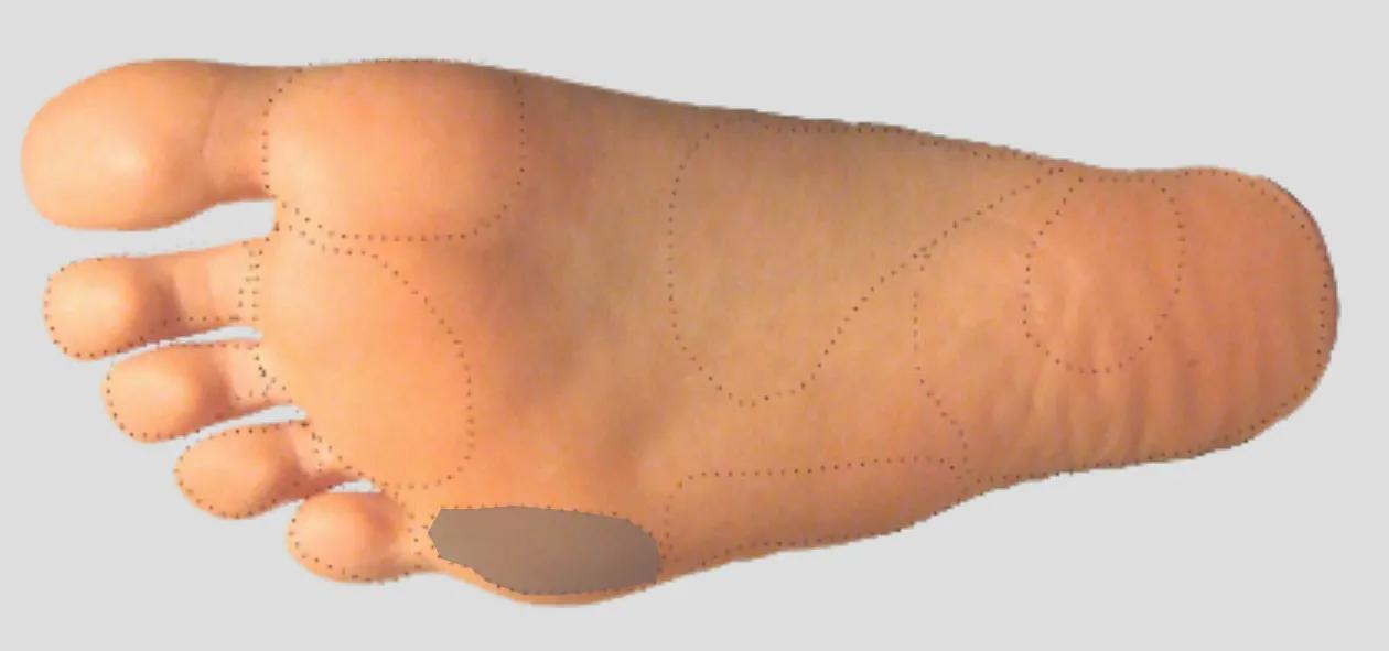 足踝外侧足底疼痛,内踝下方靠近足底的哪个位置痛