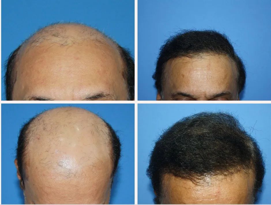 胸毛腿毛的毛囊能植发吗,胸毛可以用来植发嘛