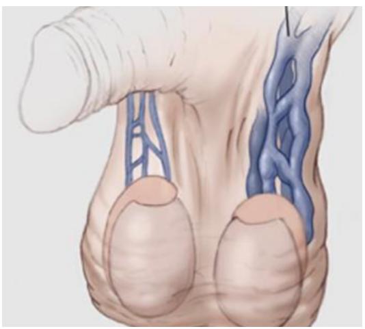 偶尔睾丸有坠痛感,睾丸两侧大腿沟潮湿会影响生育吗