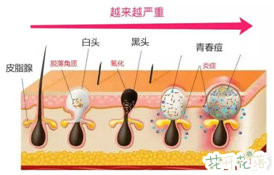 牙膏能去掉黑头吗,黑头有必要去掉吗