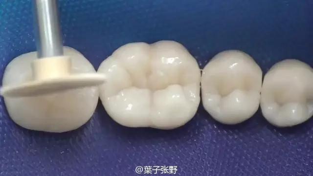 补牙疼吗补牙过程图,补牙全部过程是什么样子的