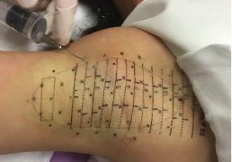 腋臭特效药一览表,miradry微波腋臭手术哪里可以做