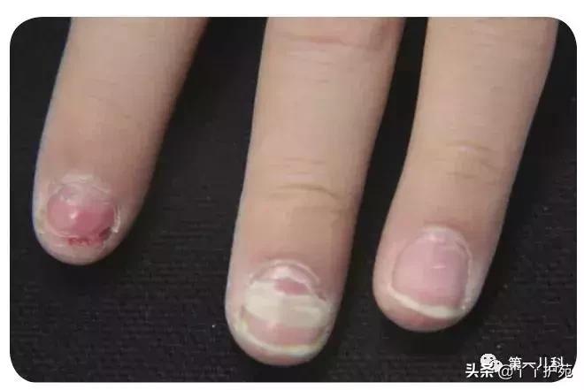 手足口病水痘荨麻疹有什么区别,麻疹水痘手足口病皮疹的区别