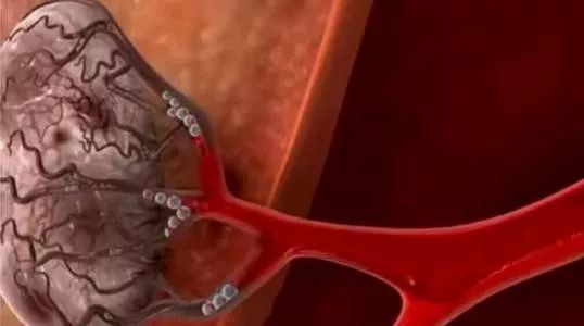 子宫肌瘤一定要手术吗,子宫肌瘤癌变手术可以根治吗