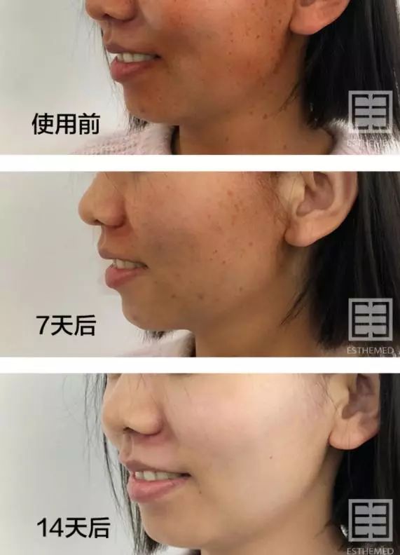 火到断货的“明星级”点斑笔,坚持每天点一下,14天养成初恋脸