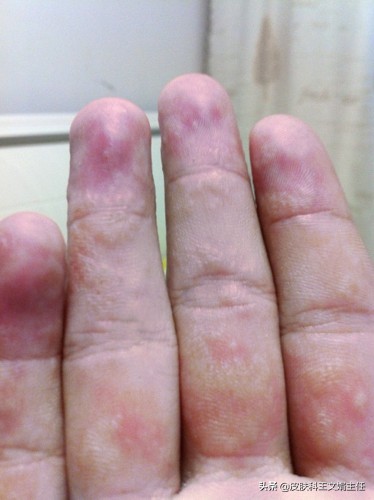 夏天皮肤病的预防,夏天常见皮肤病诊断及用药图谱