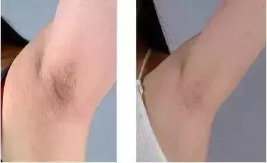 想要脱毛用什么最好,opt冰点脱毛仪器祛斑