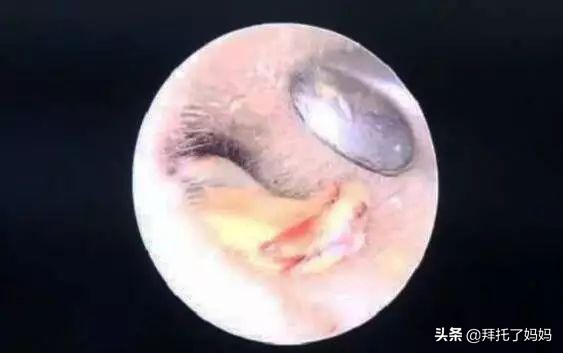 宝宝有耳屎家长一定不能这样做,男孩不掏耳屎进医院