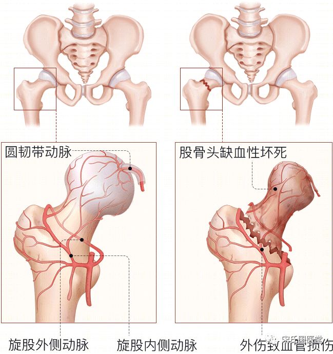 股骨头坏死漏诊图片,太康陈医生治疗股骨头坏死