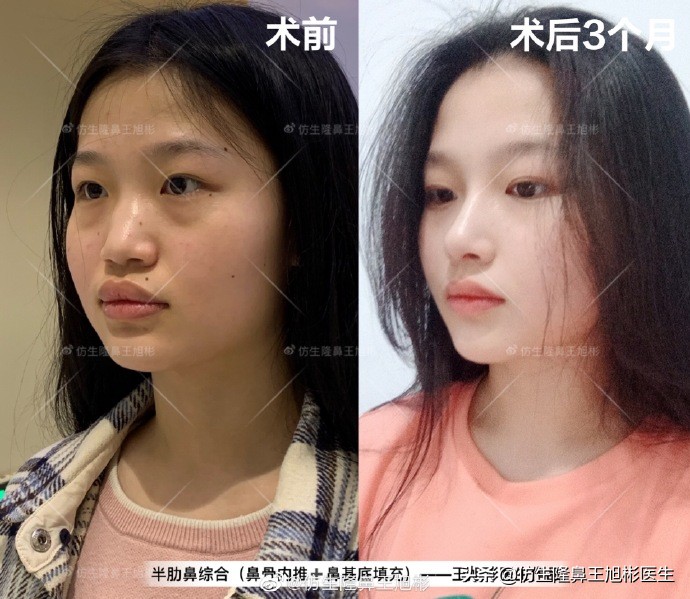 那些被鼻子“封印”颜值的鼻综合/修复案例|广州鼻整形