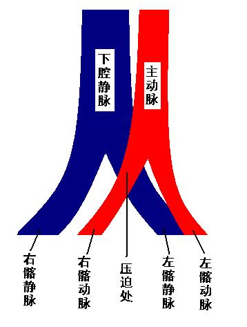 动脉压迫静脉什么原因,下肢动脉闭塞会引起小腿肿吗