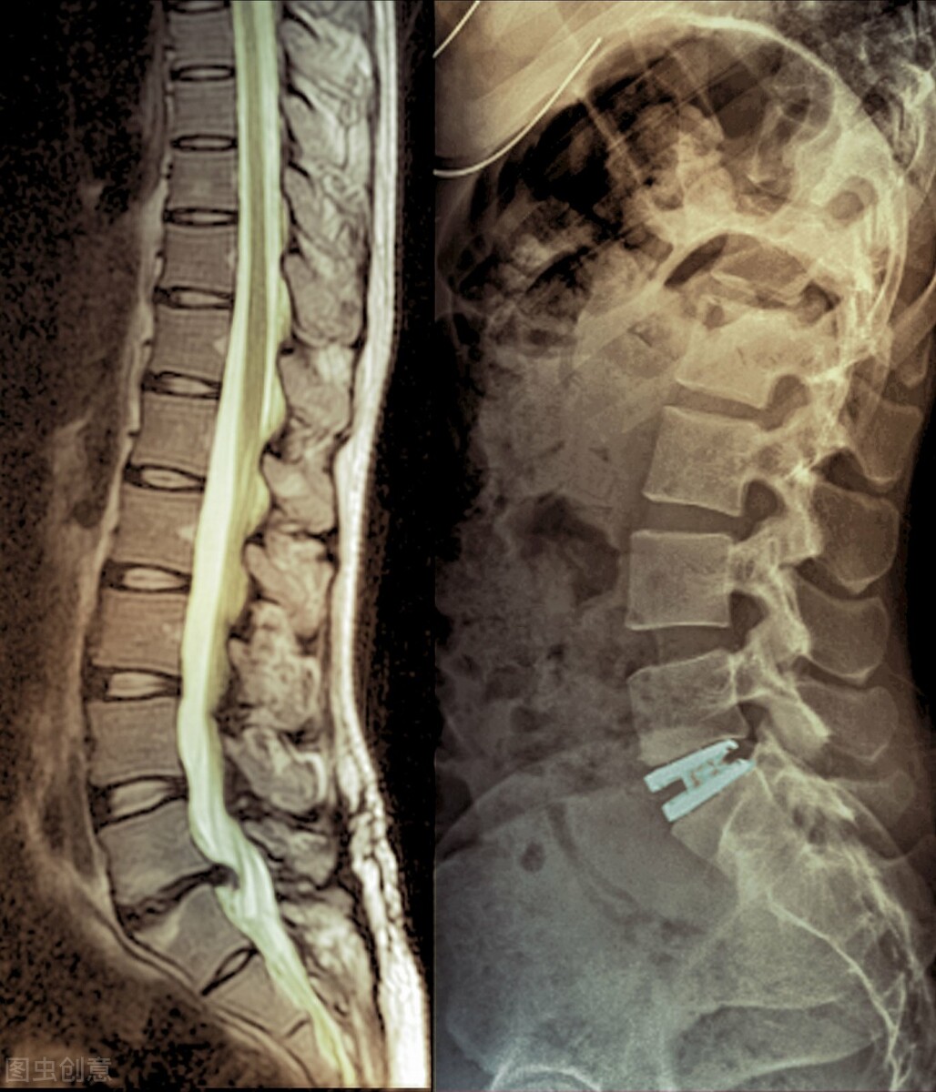 老人腰椎间盘突出最好的治疗方法,老年腰椎间盘突出最好的治疗方法