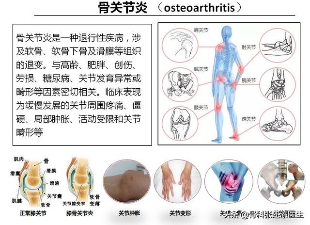 膝关节置换最坏后果,膝关节置换手术吓人