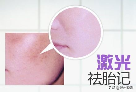 激光祛胎记，深度烧伤成疤痕，家长要求医院赔偿20余万元，法院判赔1.68万余元