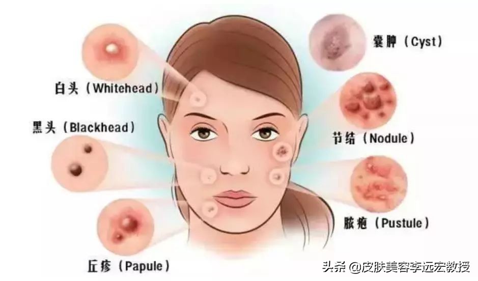 毛孔堵塞是病吗,皮肤暗沉毛孔堵塞怎么办