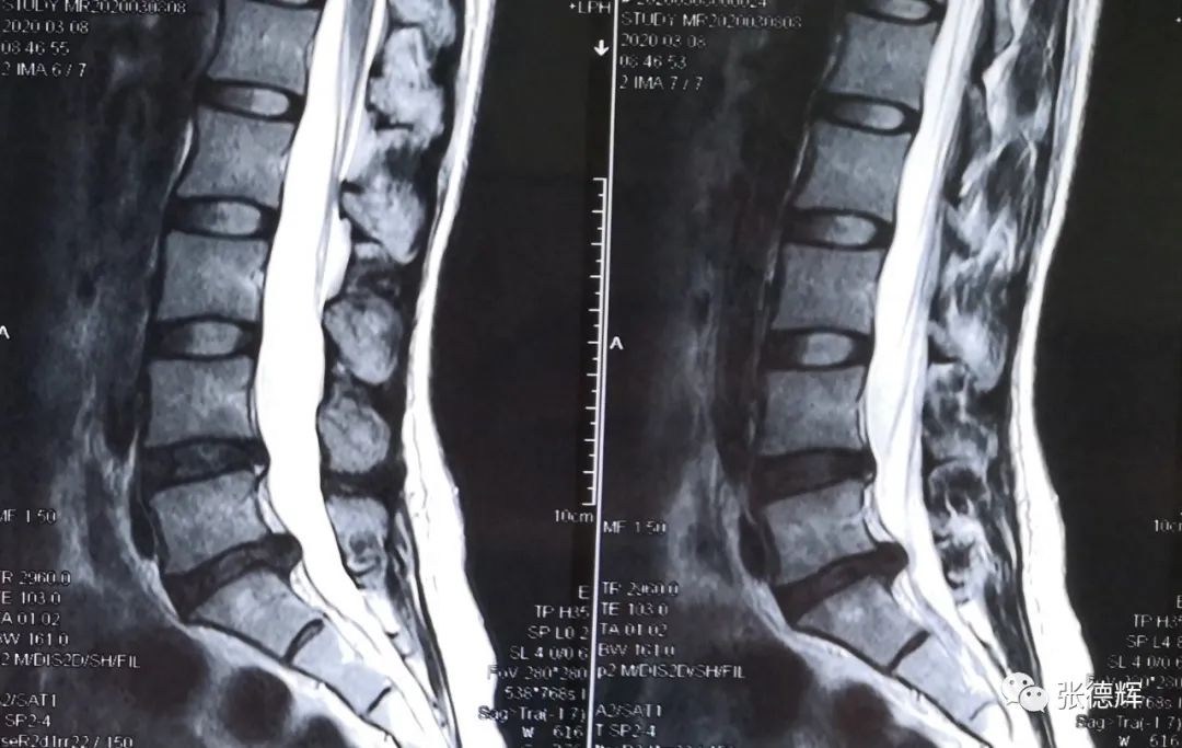 腰椎间盘突出症脊柱内镜微创手术后路镜下视频演示