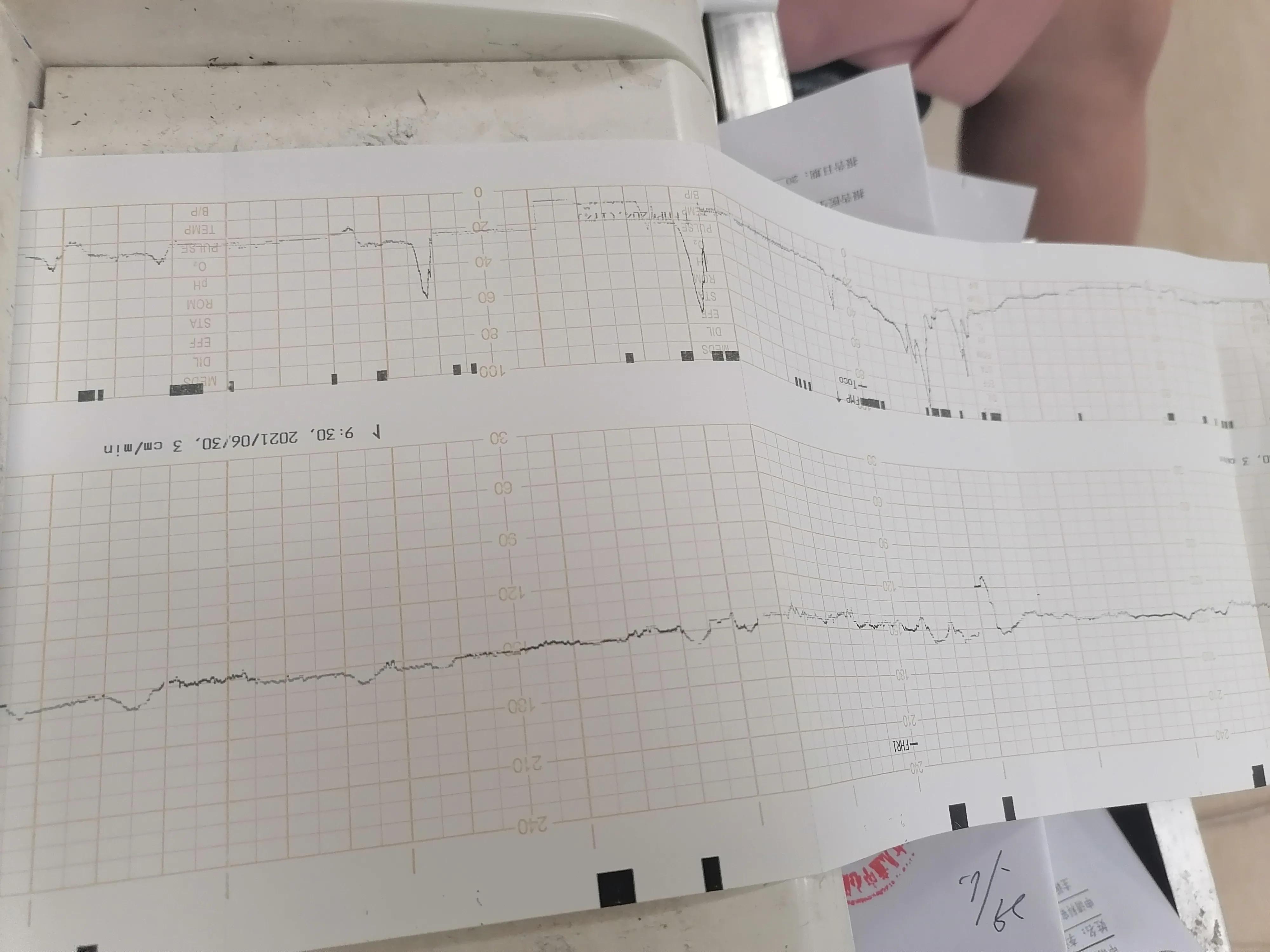 孕35周一星期做两次胎监好吗,怀孕35周做产检胎监多少分才合格