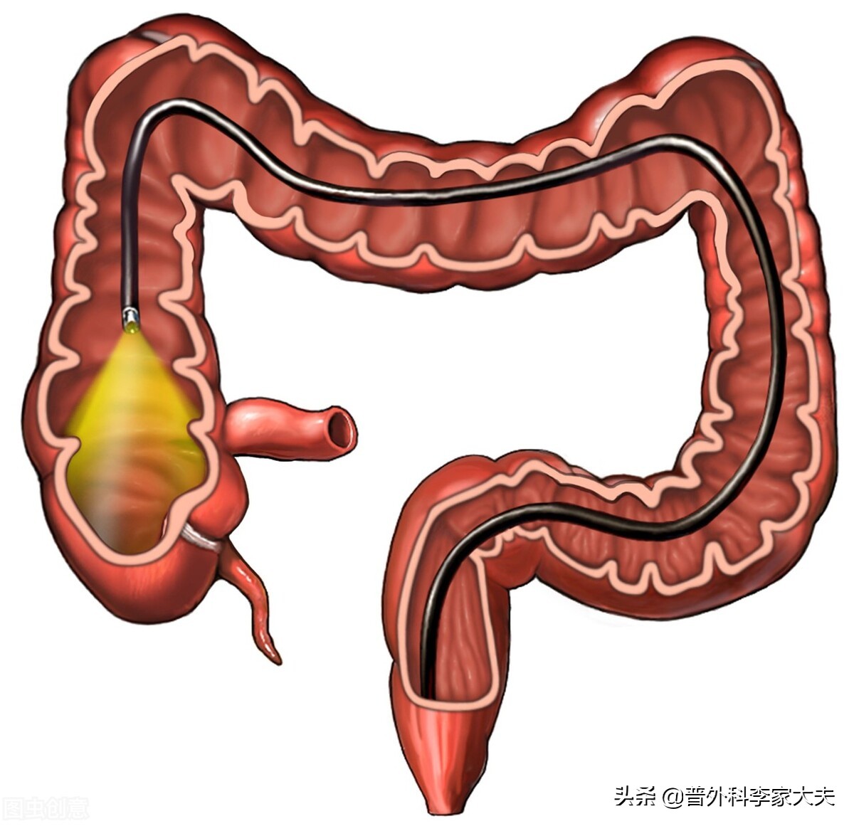 胃镜和肠镜多久做一次,黑肠病多久做一次肠镜
