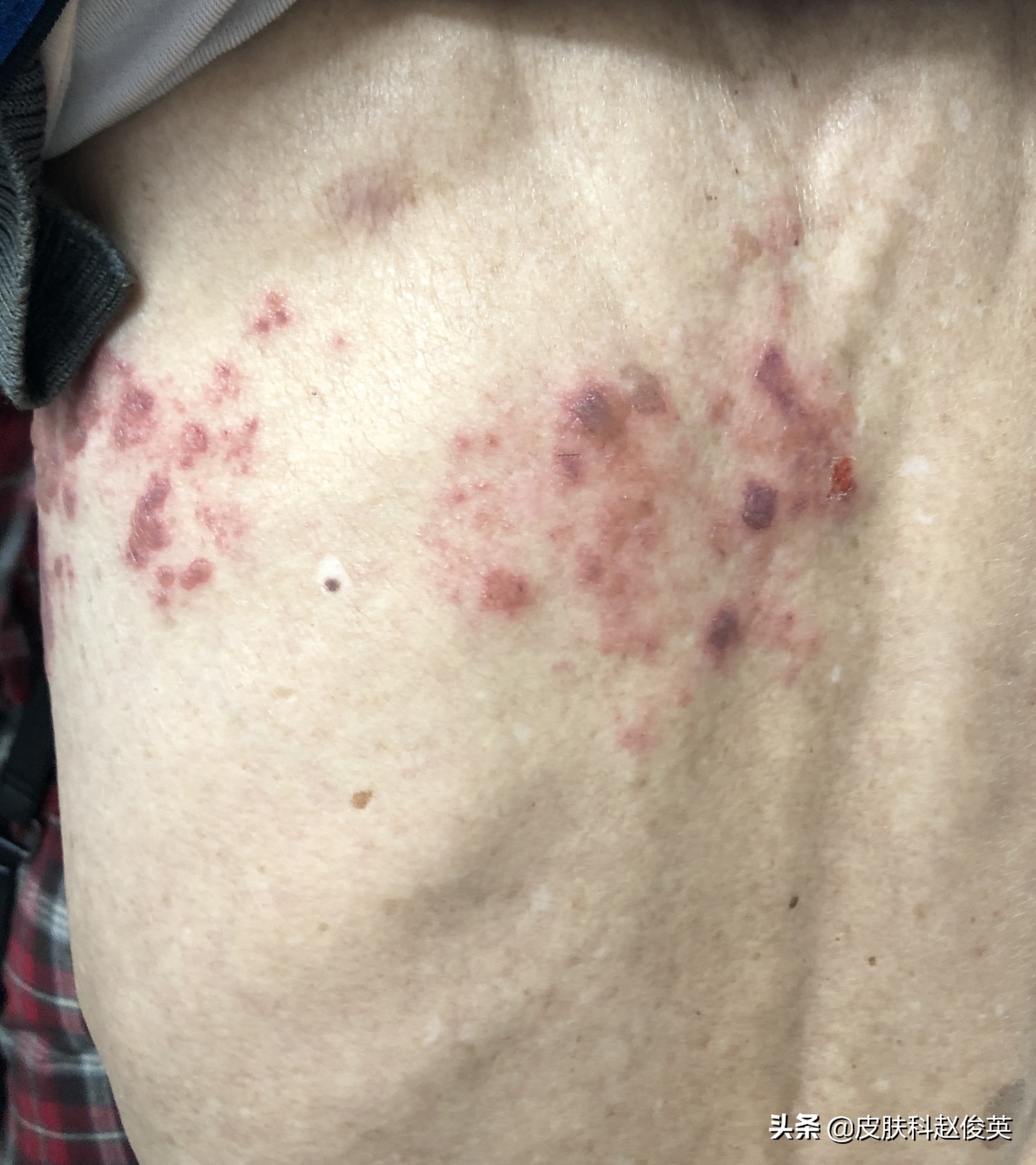 86岁老人一天内身上起了一大片水疱，不痛不痒怎么回事？