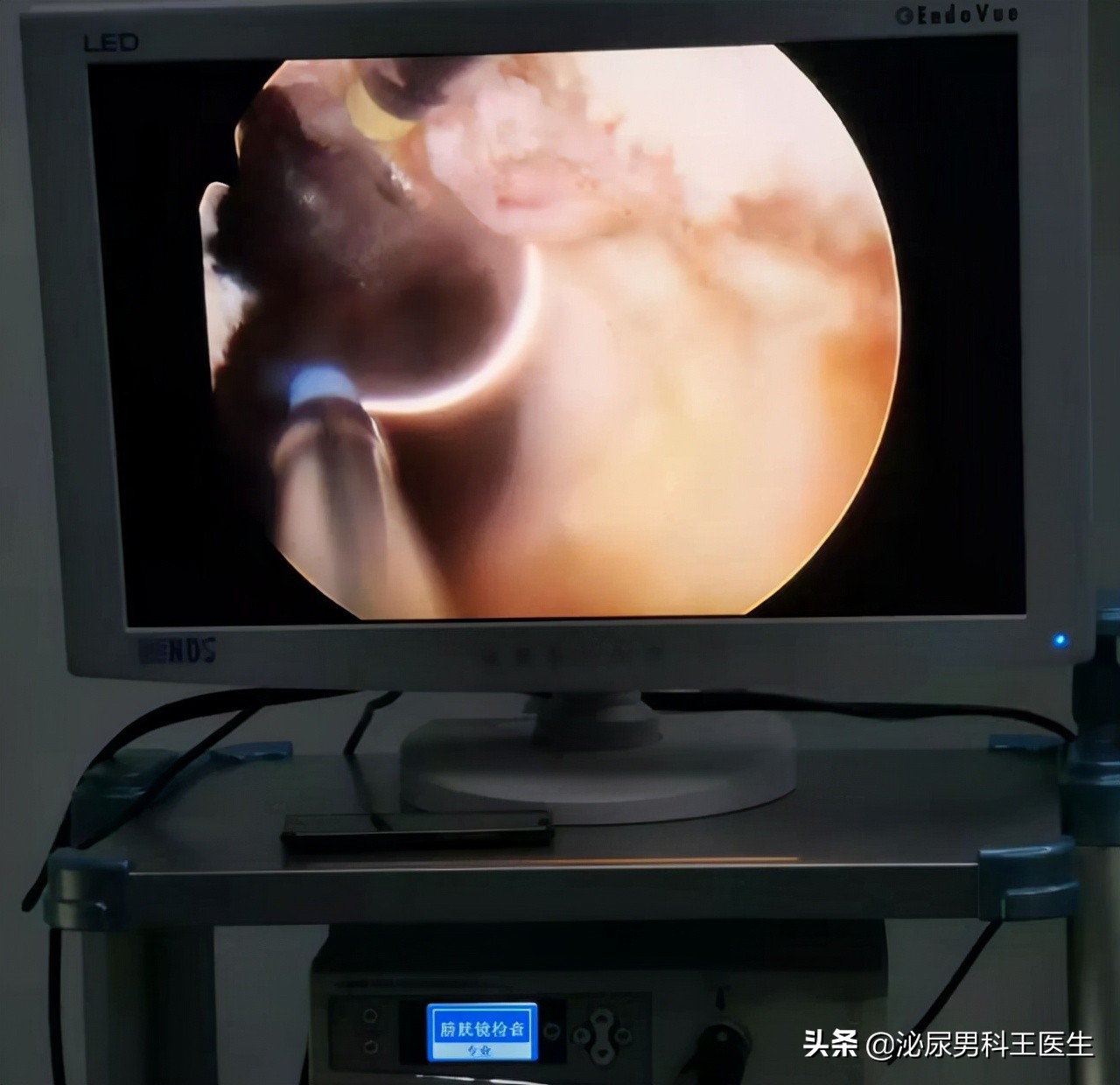 25岁前列腺增生是什么原因引起的,前列腺增生多久做一次psa检查好