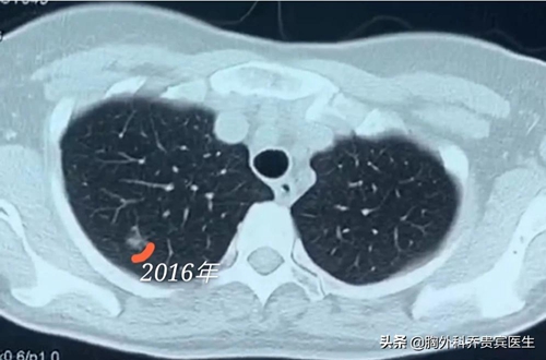 50岁女性结节,女人50以后查出来有结节怎么治疗