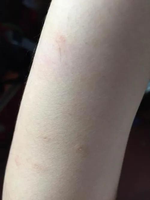 一般得了梅毒以后还能治好吗?