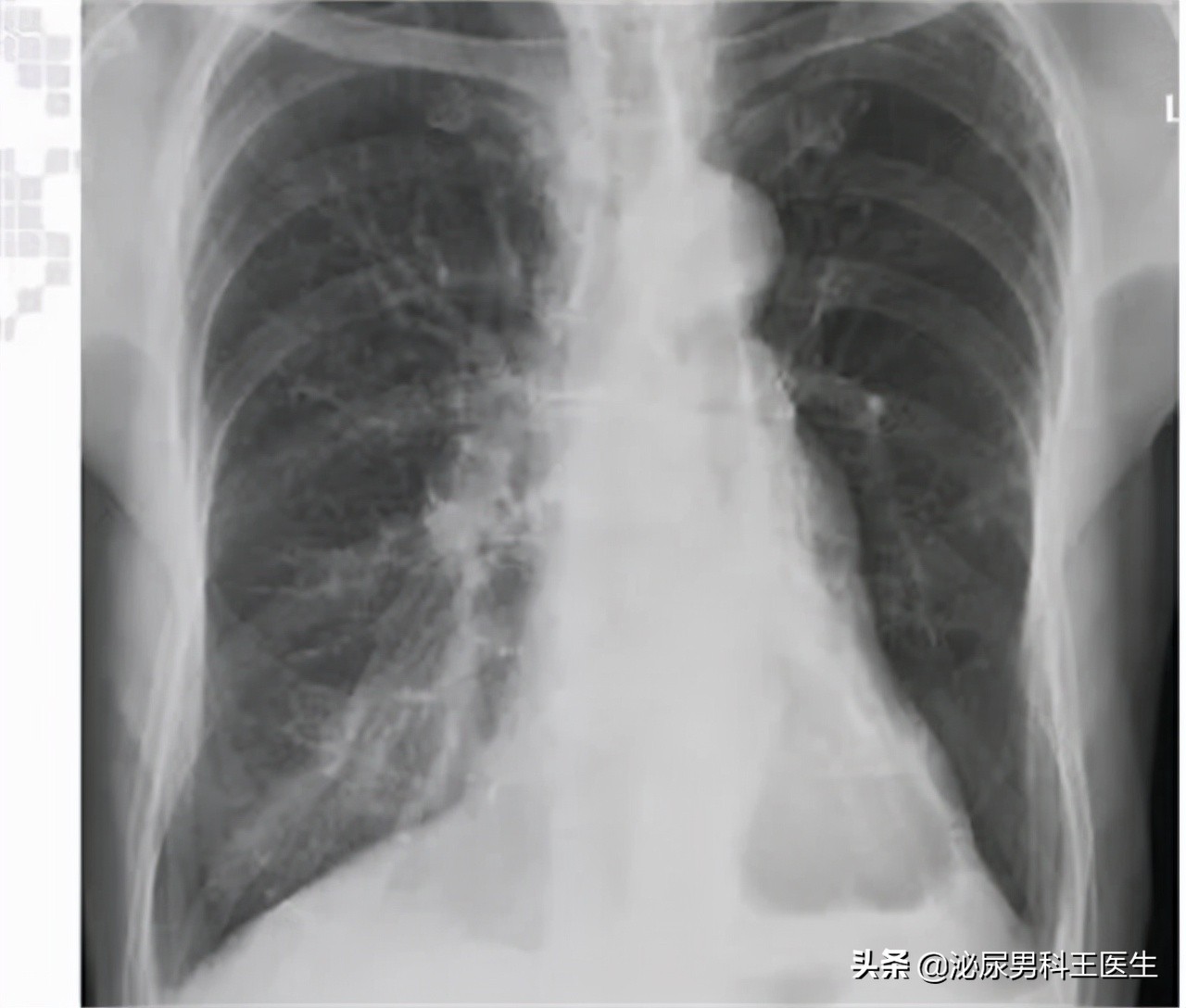 常吃西地那非对心脏有害吗,常吃西地那非可能诱发癌症吗