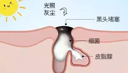 去除黑头的方法最有效的,去除黑头的最好方法简单实用