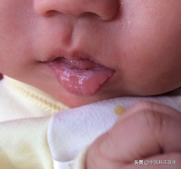 宝宝鹅口疮可以涂紫药水吗,宝宝鹅口疮长期涂制霉菌素好吗