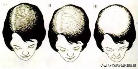 雄激素性脱发的中医认识,雄激素性脱发怎么诊断