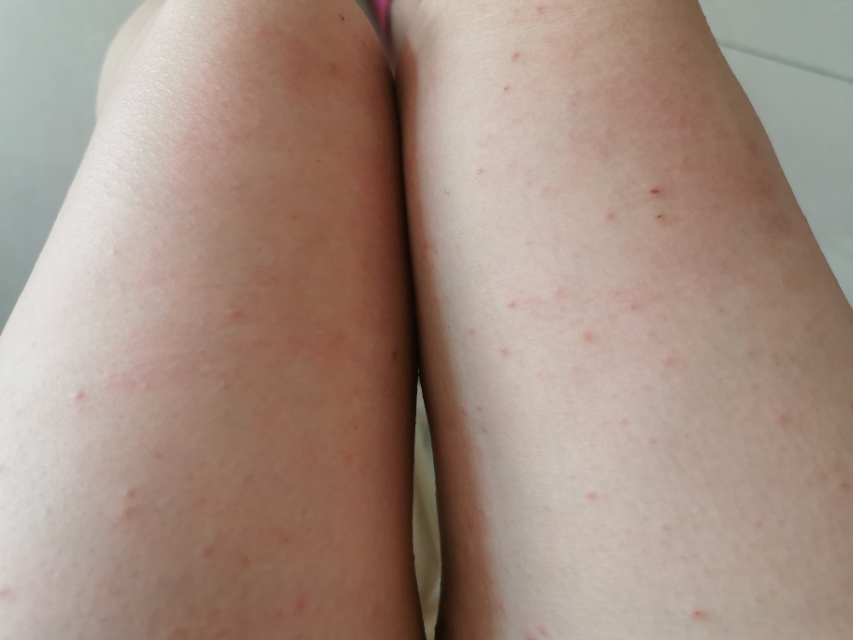 皮肤过敏怎么查过敏源多少钱,皮肤过敏过敏源有哪些