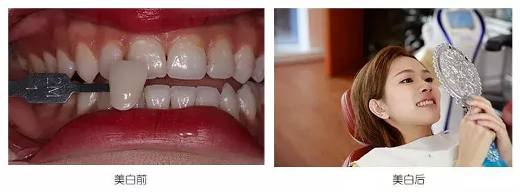 皓齿美白牙齿多少钱,皓齿美白导致牙齿敏感
