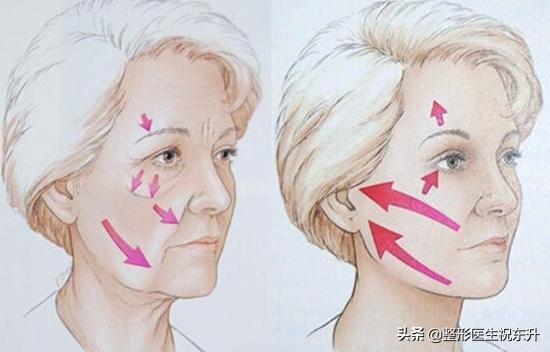 30岁脸部松垮下垂要做拉皮吗,35岁面部松弛怎么办