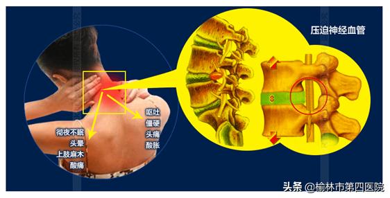 教一下颈椎锻炼方法,教你颈椎按摩操