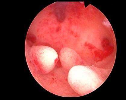月经老不干净是内膜的原因吗,月经老是不干净警惕内膜病变