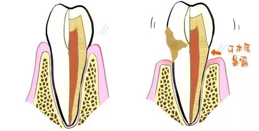 洗牙到底是伤害牙齿还是保护牙齿,洗牙对牙齿伤牙吗
