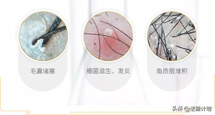 头皮发痒头皮屑多有小疙瘩怎么办,头皮严重发痒头皮屑多小妙招