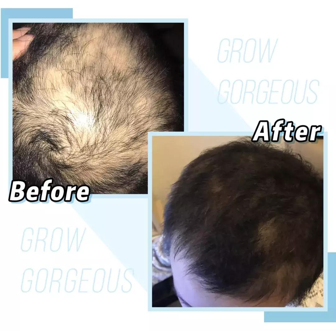 赵丽颖秃头照,赵丽颖秃顶原因