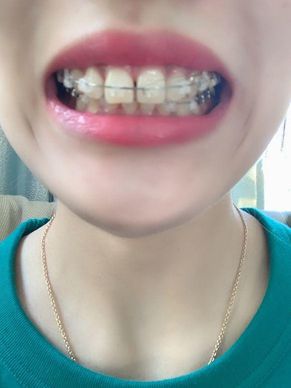 牙套日记一年级,牙套日记在线观看