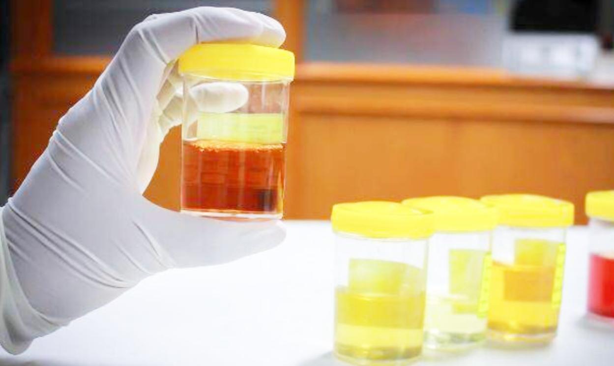 发现小便颜色不对,尿尿颜色不对查什么科