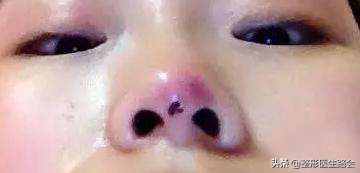 线雕隆鼻做出来不平,线雕隆鼻为什么没什么改变