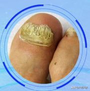 拯救酒糟鼻、脚气、灰指甲、疥疮，最简单便宜的方法！