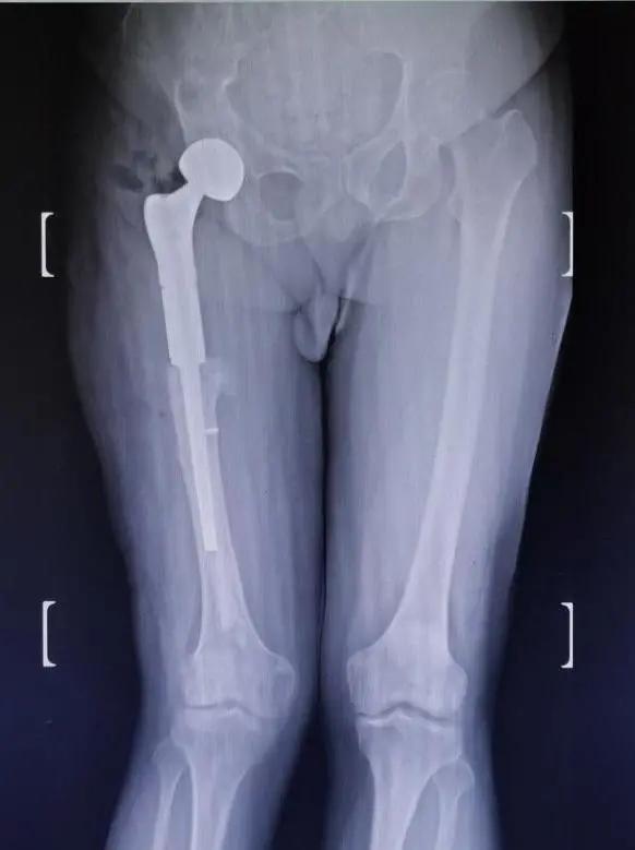 男子脚骨折去医院,男子脚伤手术后仍一瘸一拐