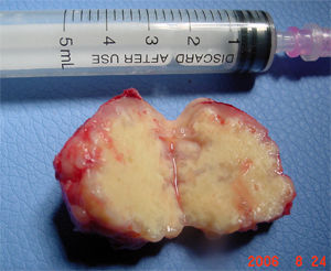脑囊虫病手术治疗方法及效果,脑包虫治疗方法和费用大概多少